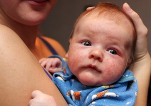 Eczema la copii - cum o tratezi pana ajungi la medic