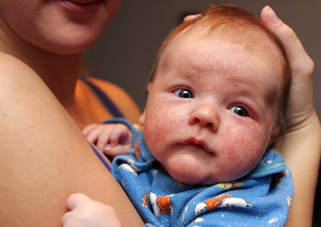 Eczema la copii - cum o tratezi pana ajungi la medic